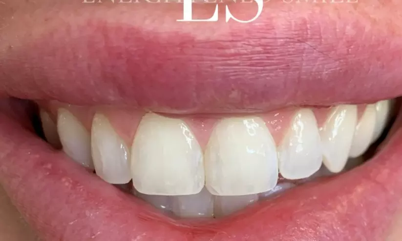 Experience Enlightened Teeth Whitening with options for 30 or 60 minute sessions, offering up to 46% off for a radiant smile - Primary Image