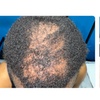 Image 2: Fuller & Healthier Scalp: 2, 4, or 6 Procell Hair Restoration Sessions