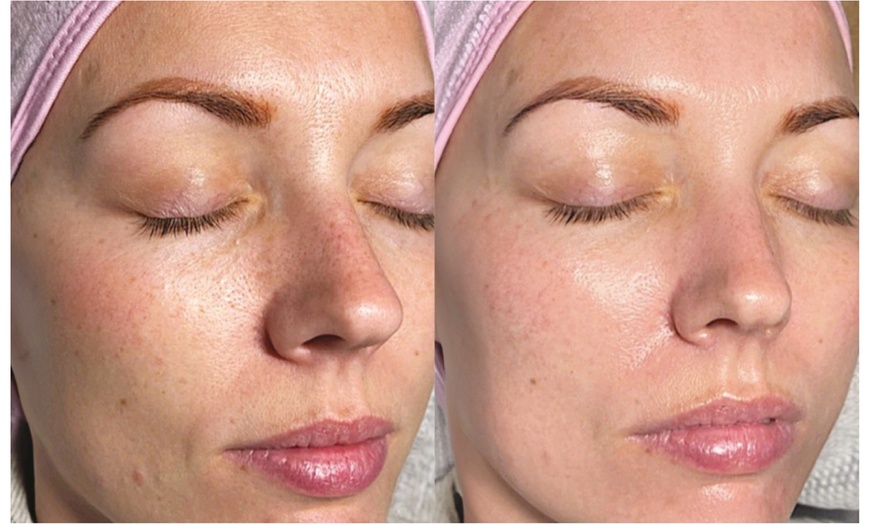 Image 2: Get a Glowing Complexion with a Hydrafacial Treatment!