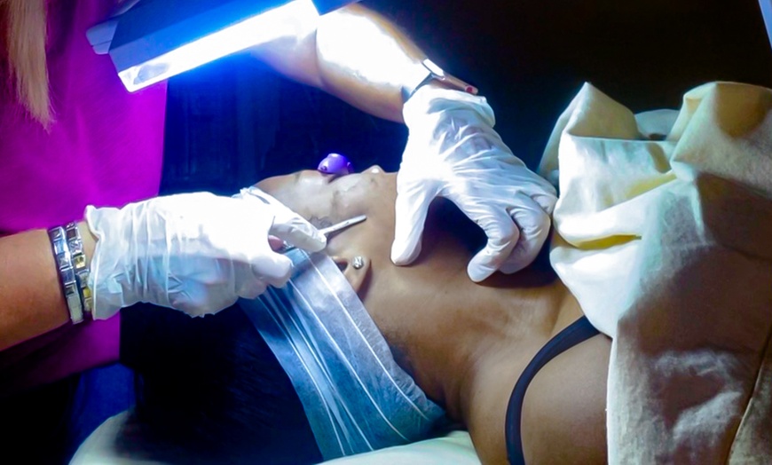 Image 2: Get 1, 2 or 3 Microdermabrasion or Dermaplaning Treatment with Facial 
