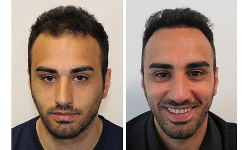 Image 2: Transform Your Look with 1000, 2000, or 3000 Graft Transplant