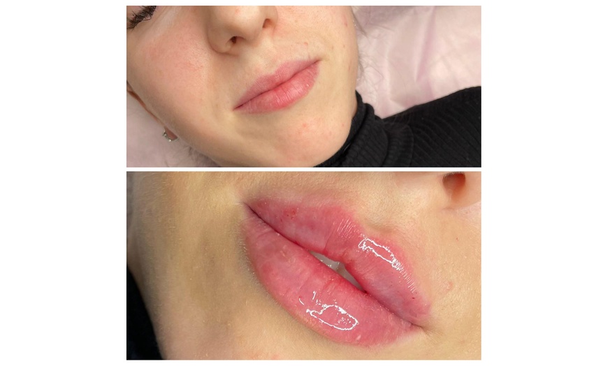 Image 6: Revitalize with 0.5 ml or 1 ml Revolax Derma Filler with Consultation