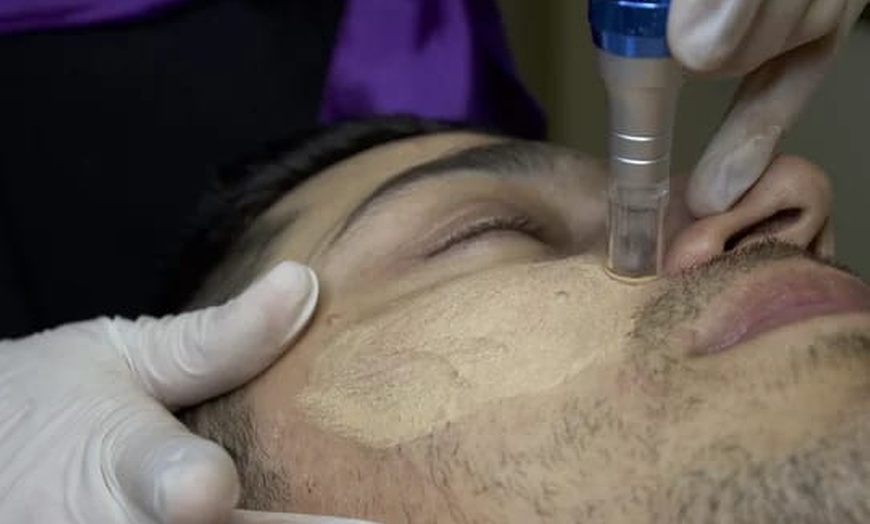 Image 2: 1 oder 2 BB-Glow- oder Microneedling-Behandlungen 