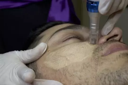 1 oder 2 BB-Glow- oder Microneedling-Behandlungen