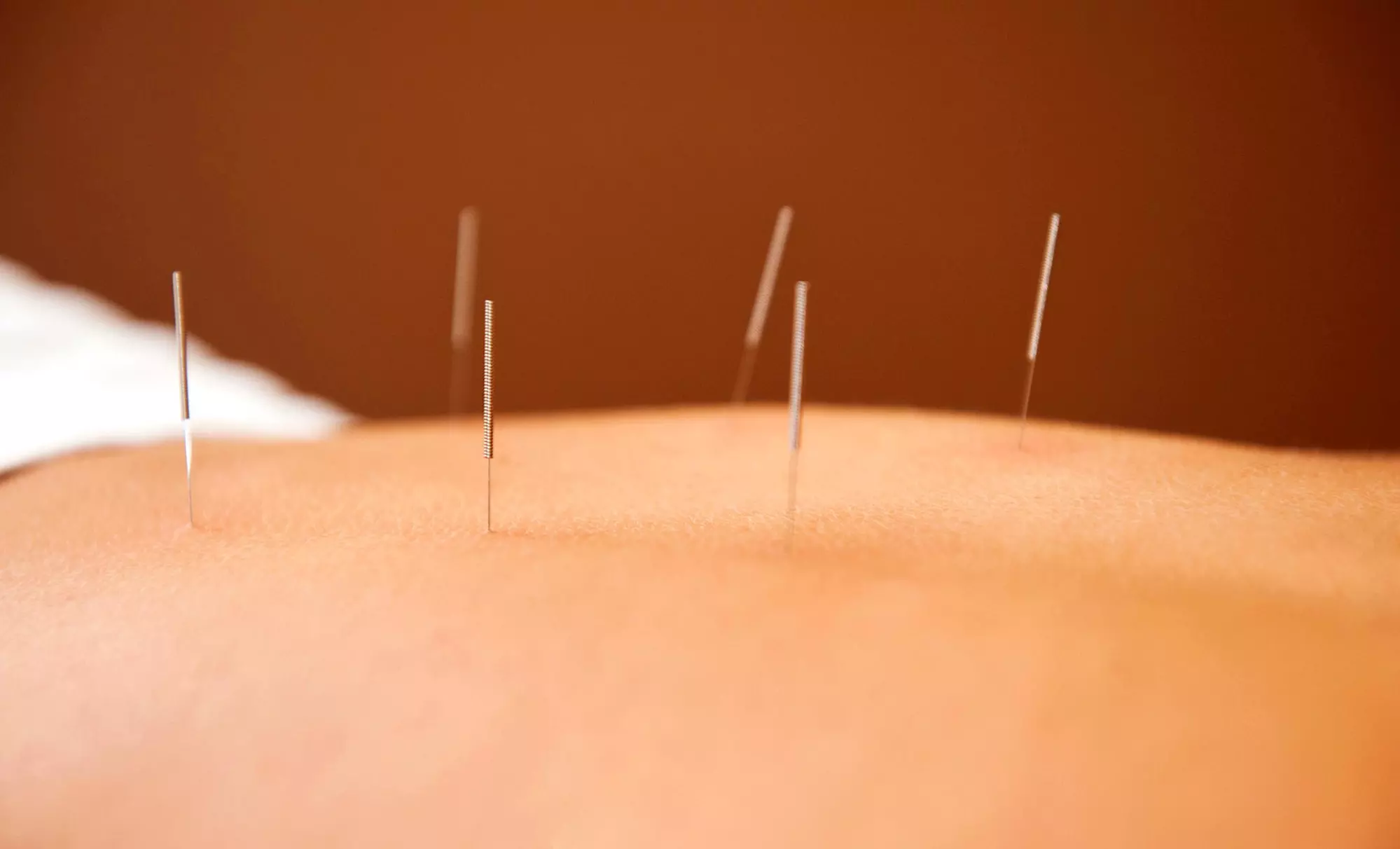 $35 for $50 Worth of Acupuncture — Westboro Acupuncture & Herbal Medicine - Primary Image