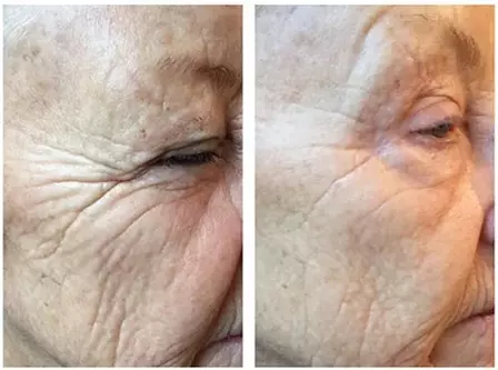 Rejuvenate with One Black Carbon Laser Treatment for Healthier Skin