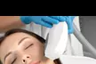Transform Your Skin with One, Two or Three IPL Photo Facials at Stephanies Cavi Lipo Spa (Up to 59% Off) - Second Medium