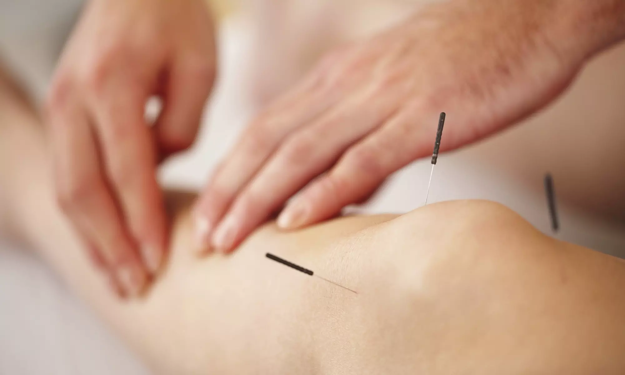 Discover holistic healing with Carin Williams Acupuncture, offering consultation and acupuncture sessions or rejuvenation facials up to 85% off - Primary Image
