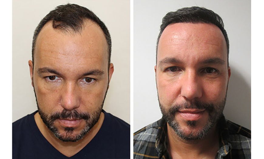 Image 3: Transform Your Look with 1000, 2000, or 3000 Graft Transplant