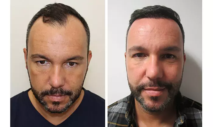 Up to 54% Off on Hair Restoration - Implants at My Health and Wellbeing Clinic