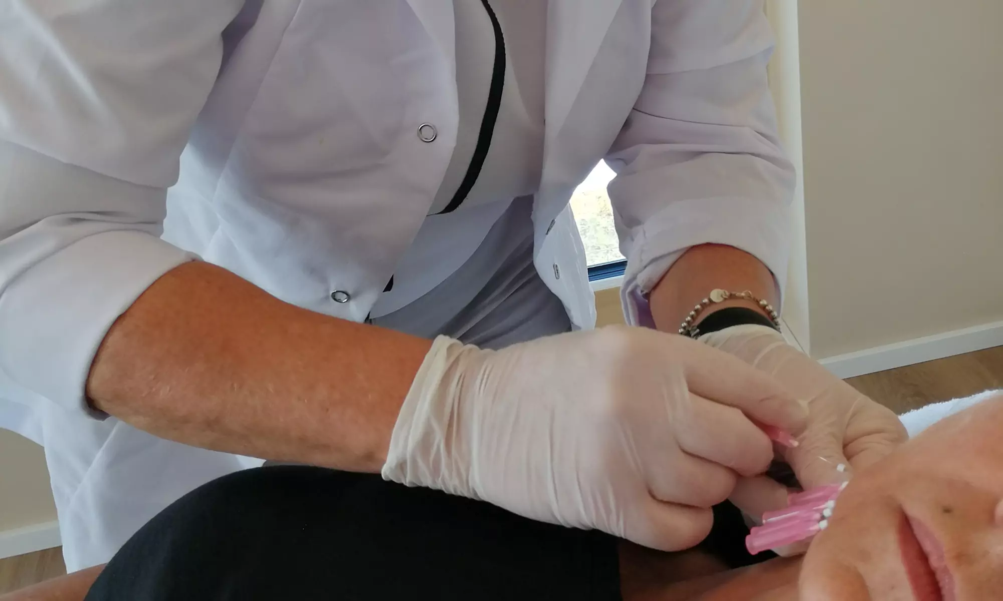 Fadenlifting für das Gesicht