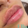 Image 4: One Session of 0.5ml,1ml or 2ml Dermal Filler With Consultation