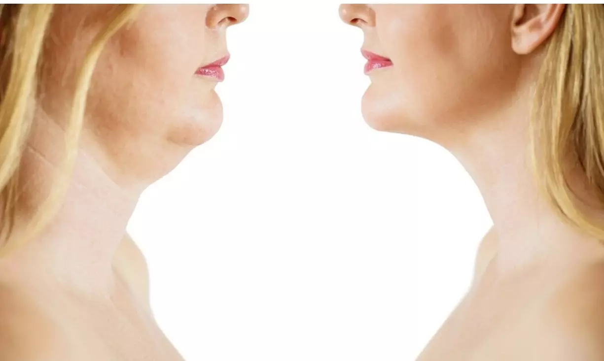 1 of 3x dubbele kin-cryolipolysebehandeling van 40 minuten