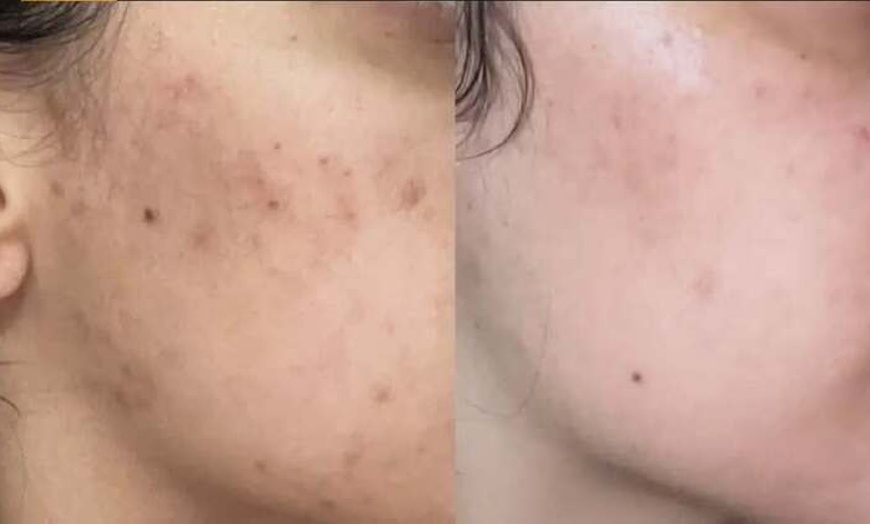 Image 1: Revitalize Your Skin with a Microneedling Session