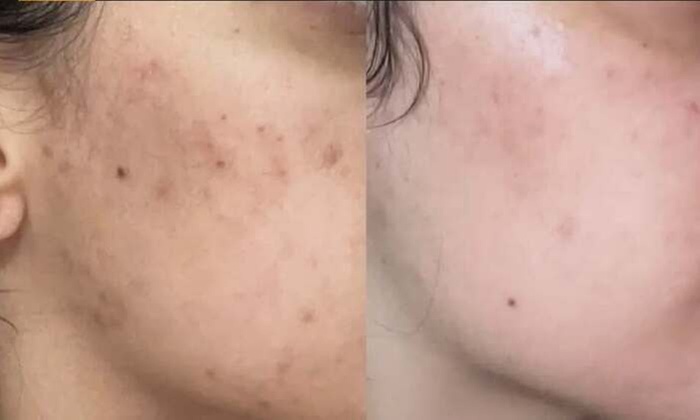 Revitalize Your Skin with a Microneedling Session