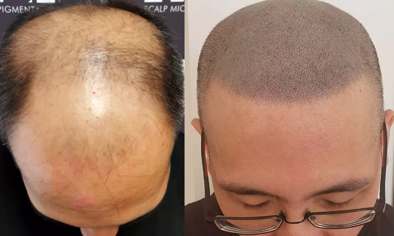 Crown, Half, or Full Scalp Micropigmentation at Illusion Scalp Micropigmentation (Up to 51% Off) - Second Medium