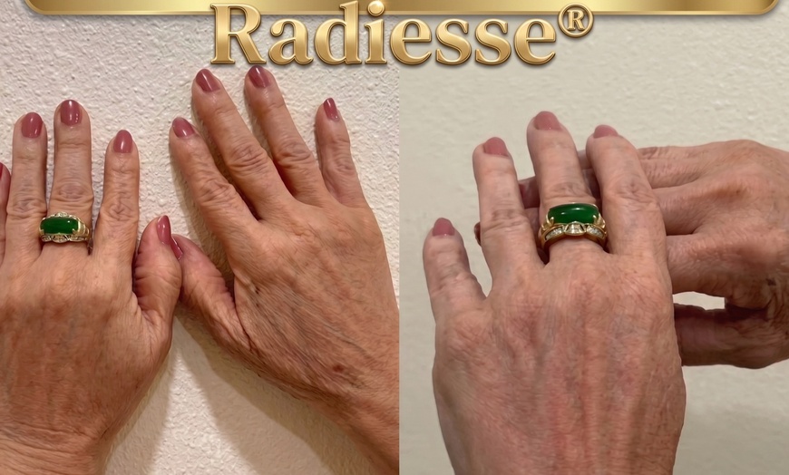 Image 4: 35% Off Sculptra or Radiesse at One Beauty Aesthetics