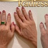 Image 4: 35% Off Sculptra or Radiesse at One Beauty Aesthetics