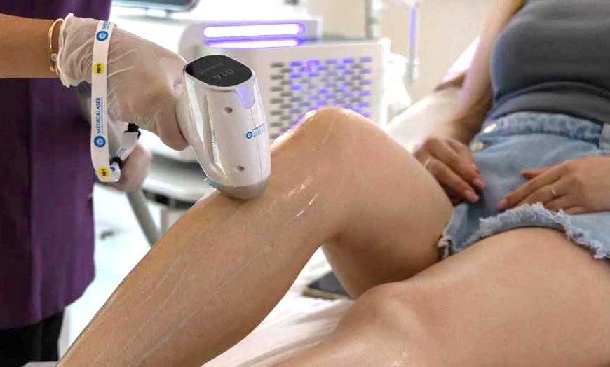 Image 1: Pour une peau lisse : épilation laser IPL, zone au choix, à Bruxelles