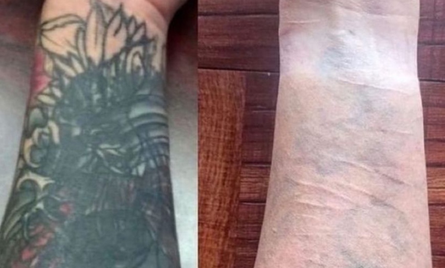 Image 2: Laser Tattoo Removal at Sublime Medical Aesthetics & Dermatology