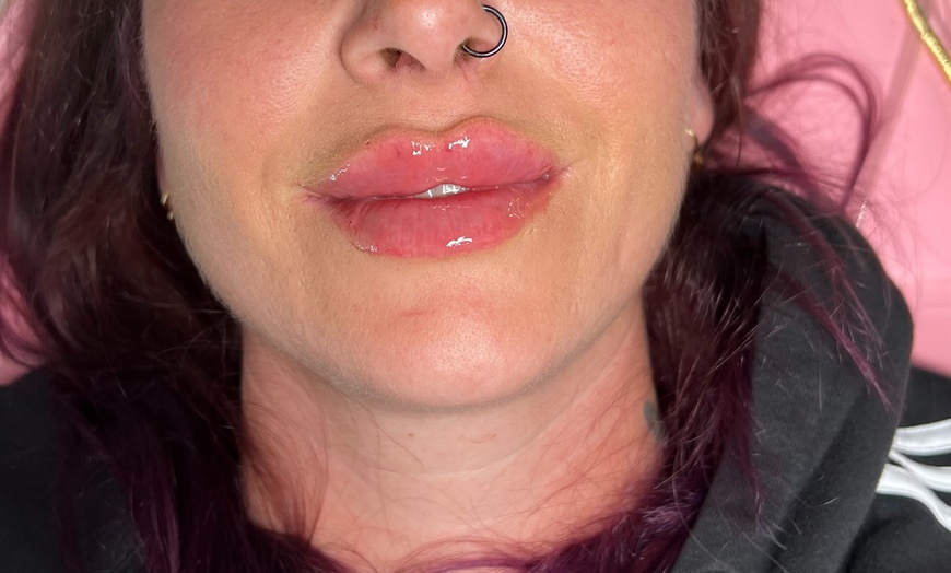 Image 5: 1 or 2 ML For Lip or Chin or Cheek with Consultation