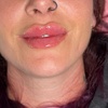 Image 5: 1 or 2 ML For Lip or Chin or Cheek with Consultation