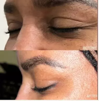 Revitalize Your Look with 20 or 40 Units of Botox