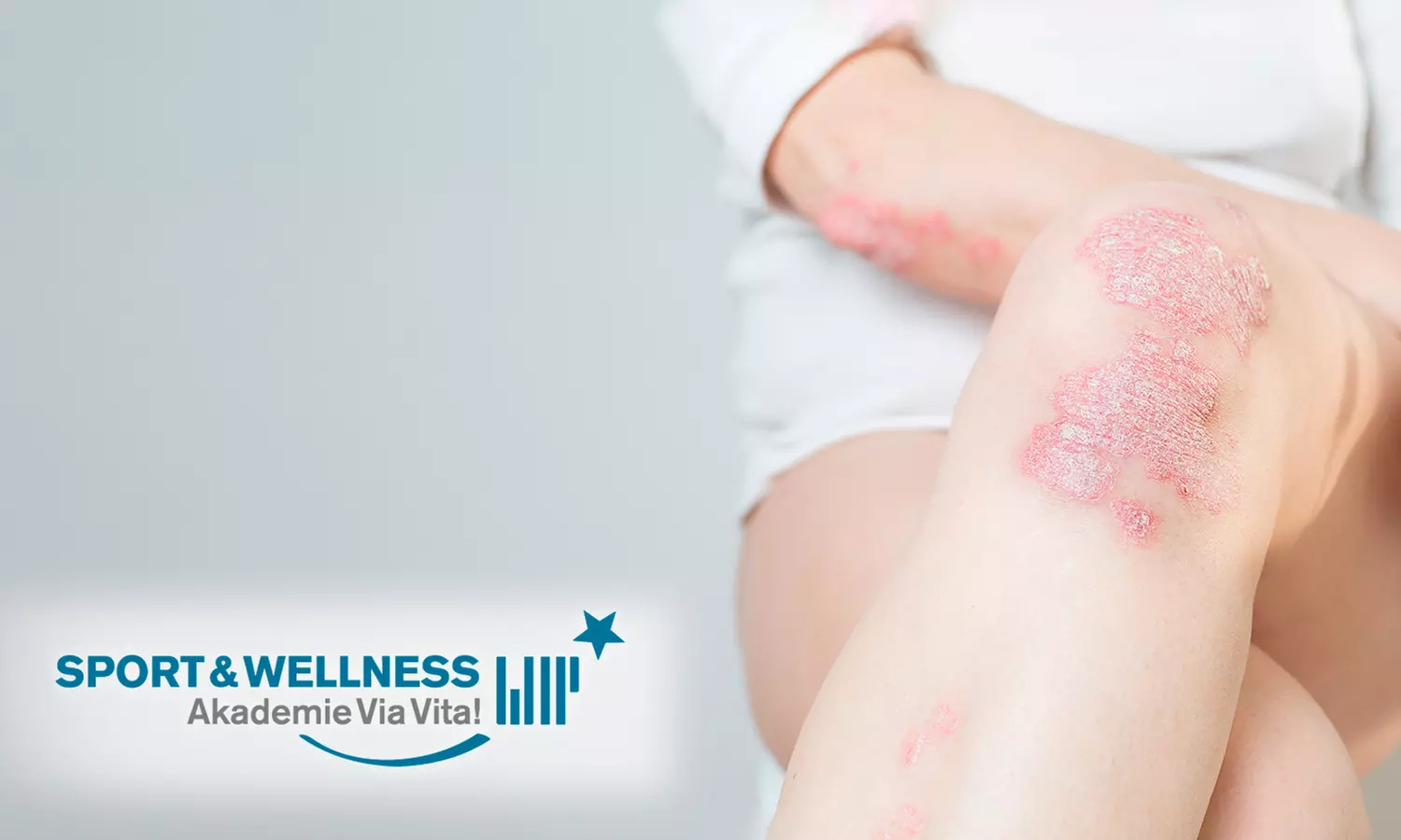 Online-Kompaktkurs „Schuppenflechte (Psoriasis)“ inkl. Digital-Zertifikat von SWAV (61% sparen) - Primary Image