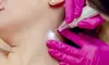 Le Lux Beautique Cutten Location Offers 5, 10 or 15 Skin Tags Removal, or More for 2mm Size (Up to 83% Off)