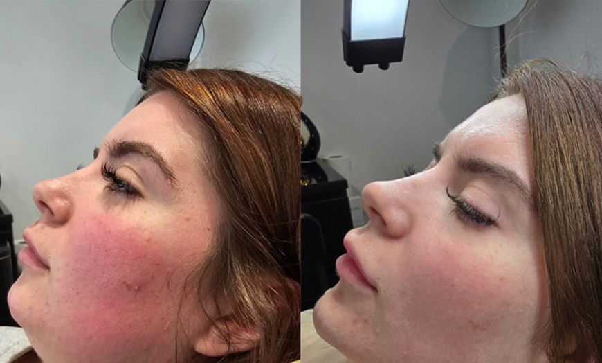 Image 2: Enhance your natural radiance with Dermal Filler