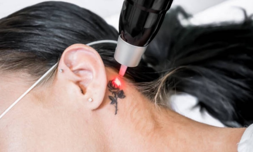 Image 5: Eliminación de micropigmentación o tatuajes con láser 