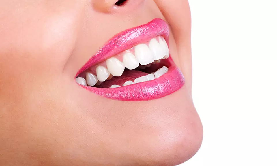 Dental Exam & Clean Pkg ($129), or In-Chair Teeth Whitening Pkg ($249) + Teeth Whitening Kit ($329) at Hebersham Dental - Primary Image