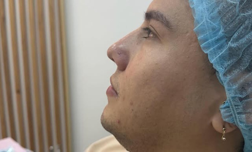 Image 7: Lip Flip or 20, 40 or 60 Units of Botox 