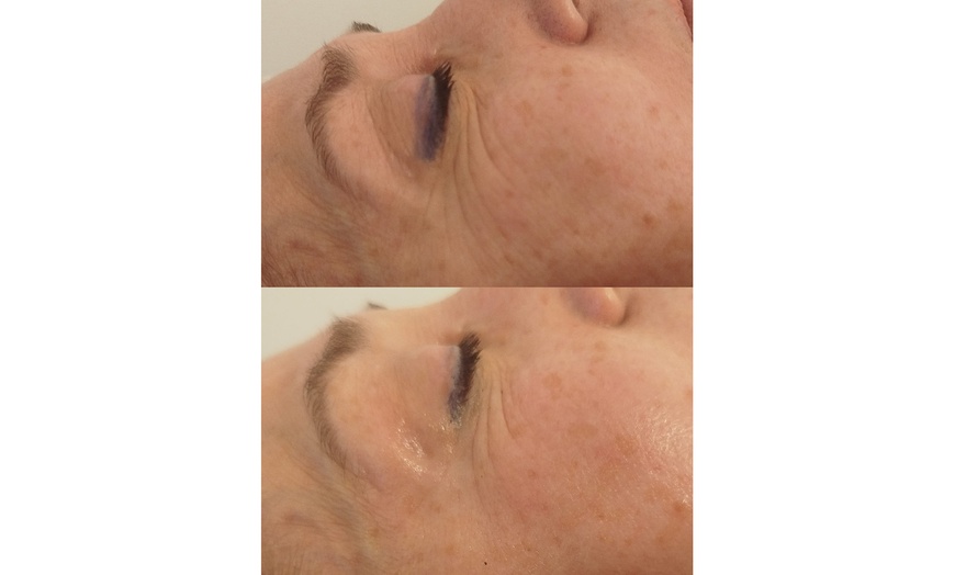 Image 8: 1 o 2 sesiones de radiofrecuencia facial o corporal Indiba