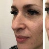 Image 1: Lumenis IPL Laser Skin Resurfacing Treatment for Face & Optional Neck