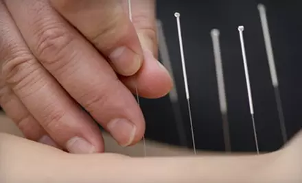 $15 for Holistic Health Assessment and Two Acupuncture Treatments (Up to $95 Value) at Limestone Community Acupuncture Clinic - Primary Image