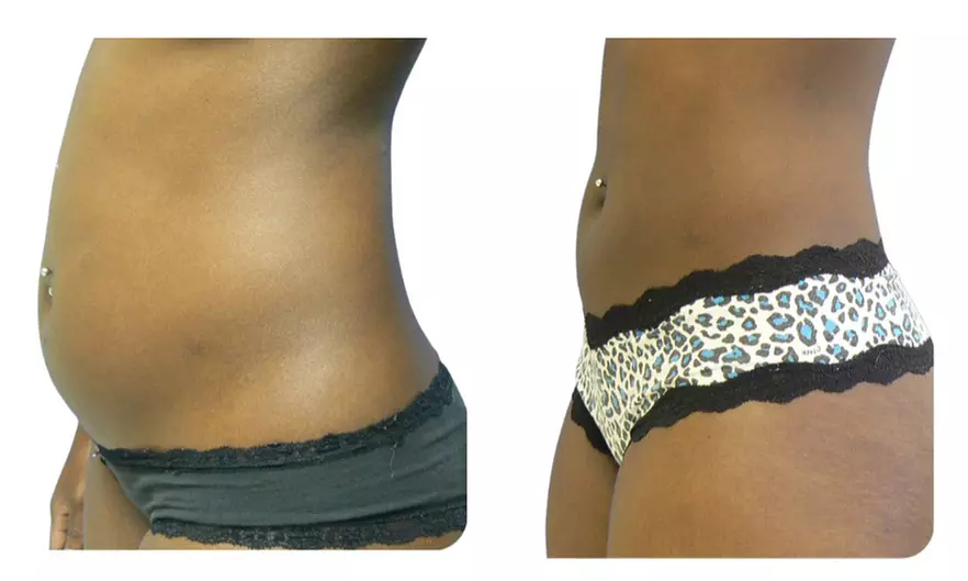 SmartLipo Triplex Laser Assisted Liposuction
