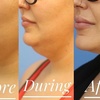 Image 1: 61% Off Kybella Injections at Skin Glow Wellness