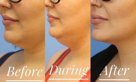 One Vial of Kybella - Skin Glow Wellness