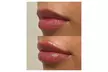 One Syringe of Juvederm Ultra or Juvederm Ultra Plus at Spa Bella Medispa (Up to 43% Off) - Second Medium