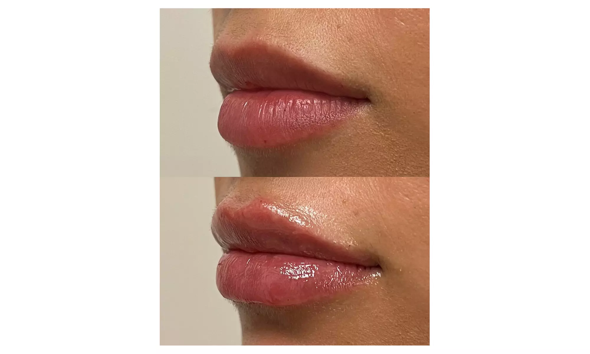 Up to 49% Off on Injection - Dermal Filler at Spa Bella Medispa
