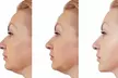 HIFU Treatment: Brow/Forehead / Eye or Jawline & Chin Lift or Full Face, Neck or Stomach or More (Up to 80% Off) - Image 2
