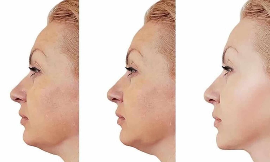 Image 2: HIFU Treatment for Brow/Forehead Lift and More Choice of Area(s)