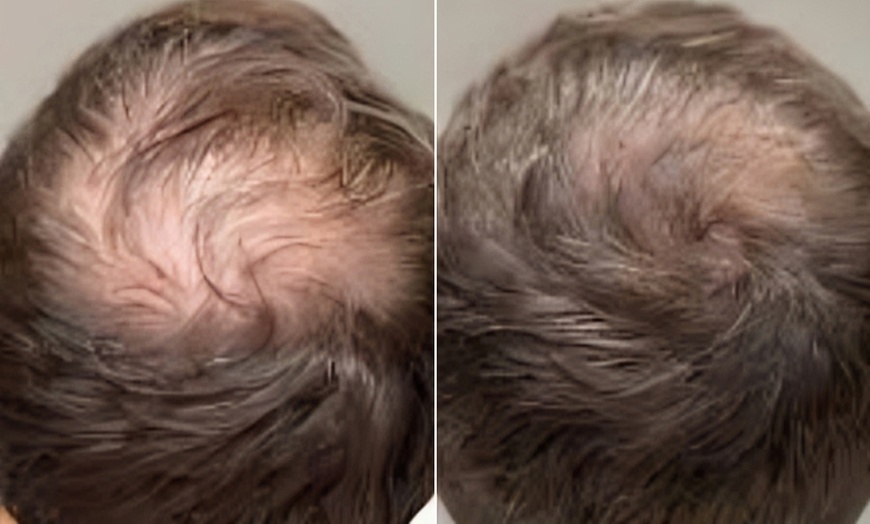 Image 2: 1, 3 o 6 sesiones de bioestimulacion o mesoterapia 