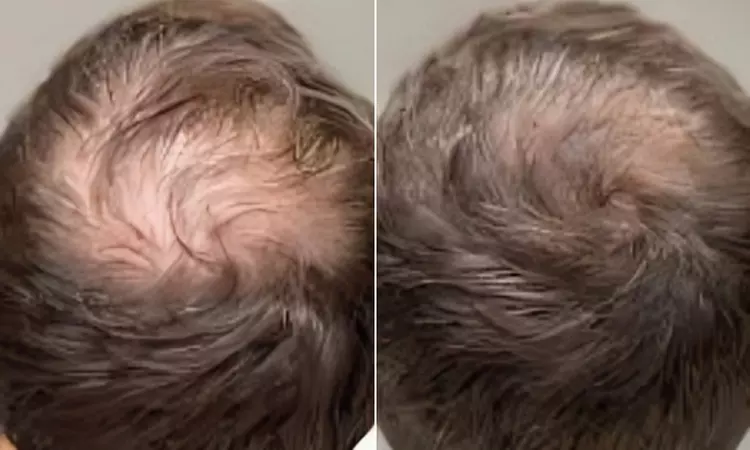 1, 3 o 6 sesiones de bioestimulacion o mesoterapia