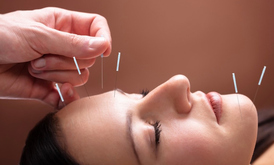 Image 2: Relieve with One, Two or Three 60 Min Choice of Acupuncture Sessions