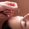 Image 2: Relieve with One, Two or Three 60 Min Choice of Acupuncture Sessions