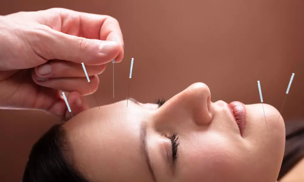 Relieve with One, Two or Three 60 Min Choice of Acupuncture Sessions