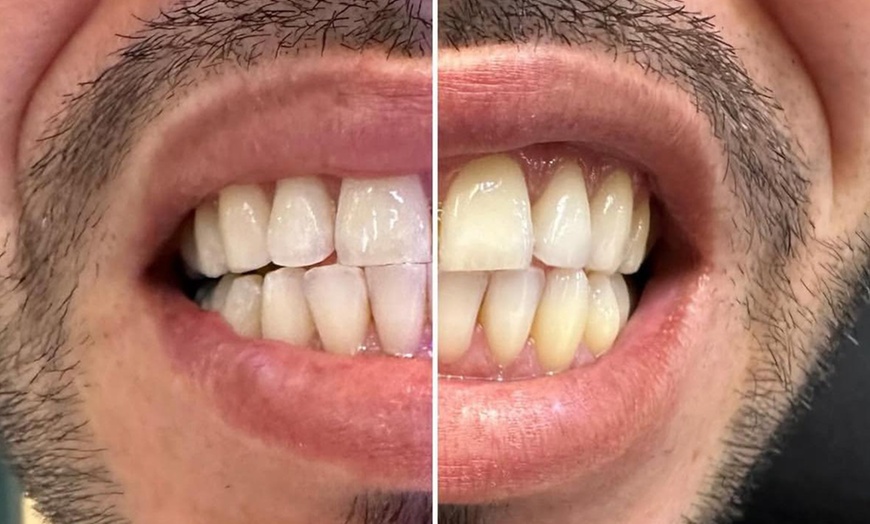 Image 9: Teeth Whitening with Carbamide Peroxide