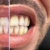 Image 9: Teeth Whitening with Carbamide Peroxide